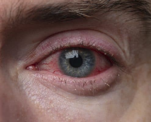 Trillium Vision Care Got Pink Eye? Know the Facts and Get Better Faster.